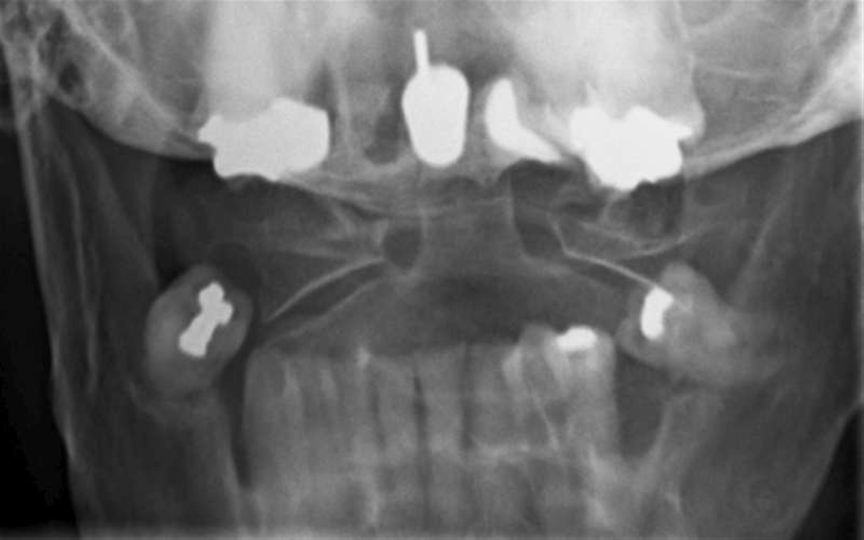 Odontoid Fracture X Ray